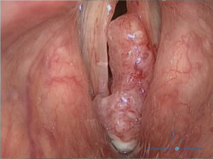 carcinoma-de-laringe