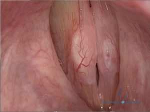 lesio%e2%95%a0un-estructural-minima-de-la-cubierta-en-ambos-pliegues-vocales