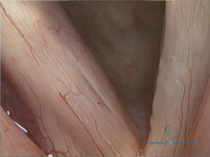 sulcus-vocalis-pliegue-vocal-derecho
